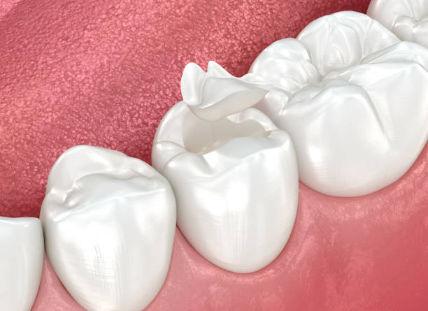 Best Dental Inlays and Onlays  in Friendly, MD